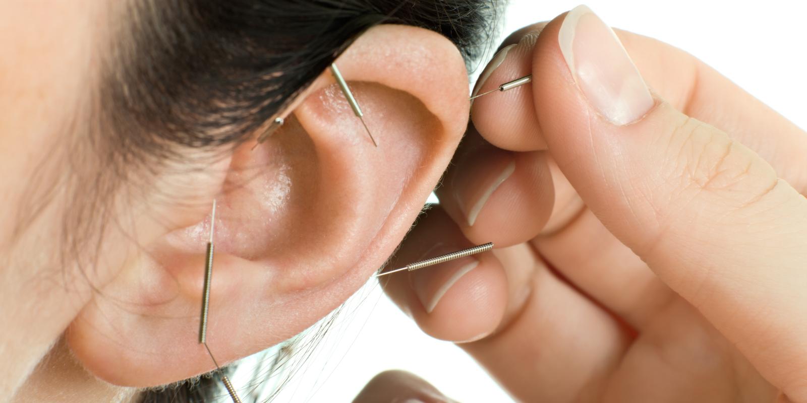 Bilde av en hvit hånd som setter akupunkturnåler i øret på en hvit person med mørkt hår.