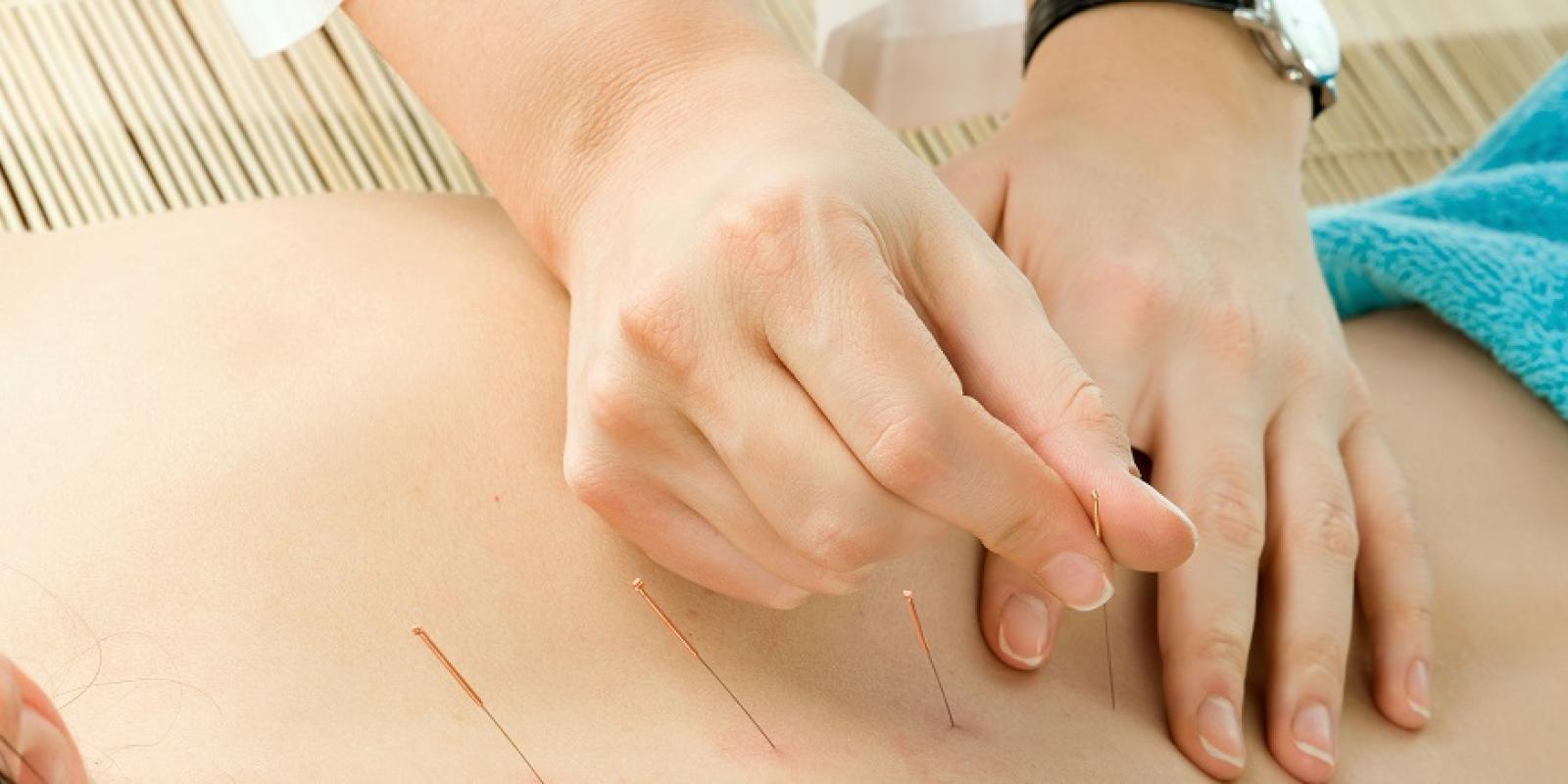 Akupunkturnåler som settes på en rygg